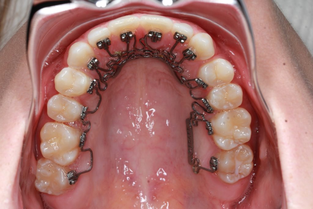 In-Ovation L MTM | Orthodontist San Diego | Clear Braces