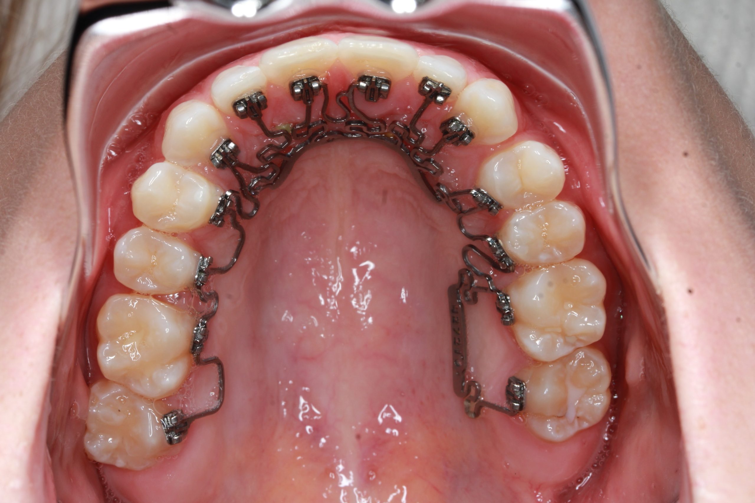 Lingual braces  Esthetic Orthodontic Treatment